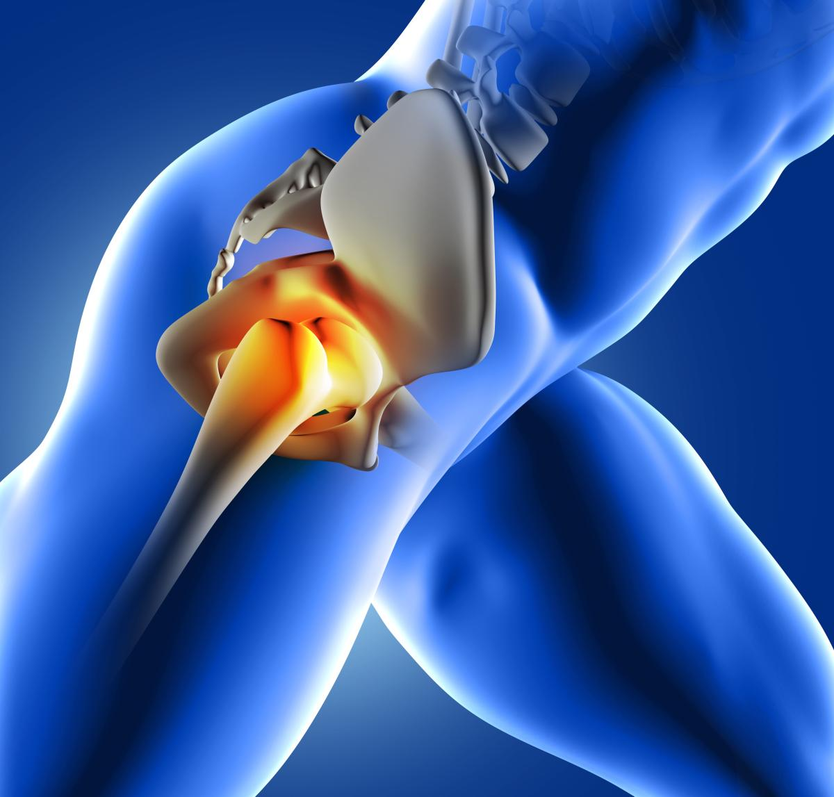 Hip Implants Explained: Materials, Approaches and Choices in Total Hip Replacement
