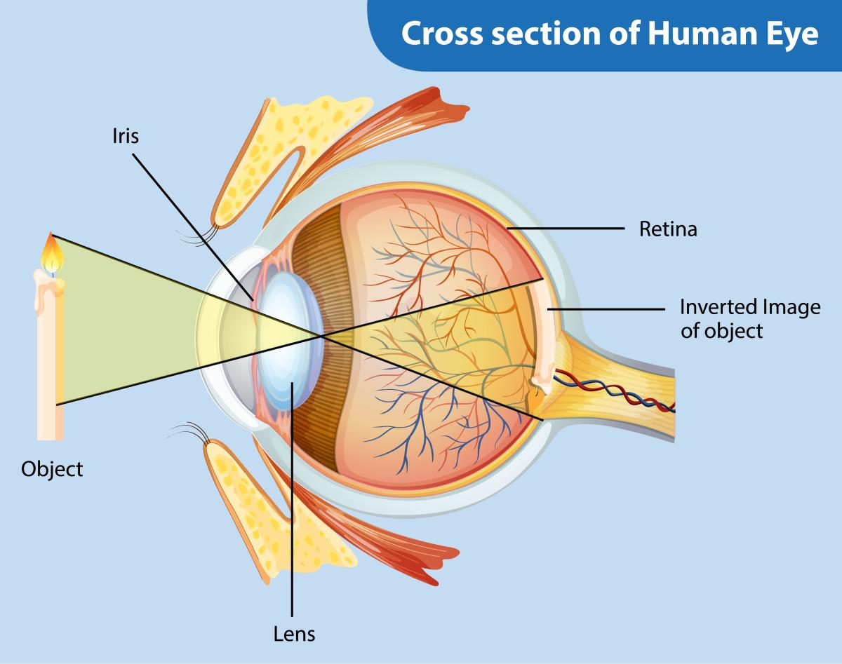 5 Types of Cataract: How to Tell Them Apart