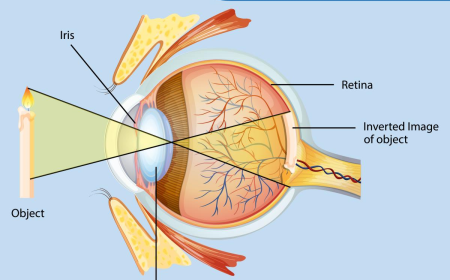 5 Types of Cataract: How to Tell Them Apart