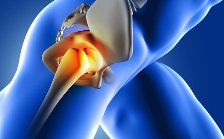 Hip Implants Explained: Materials, Approaches and Choices in Total Hip Replacement